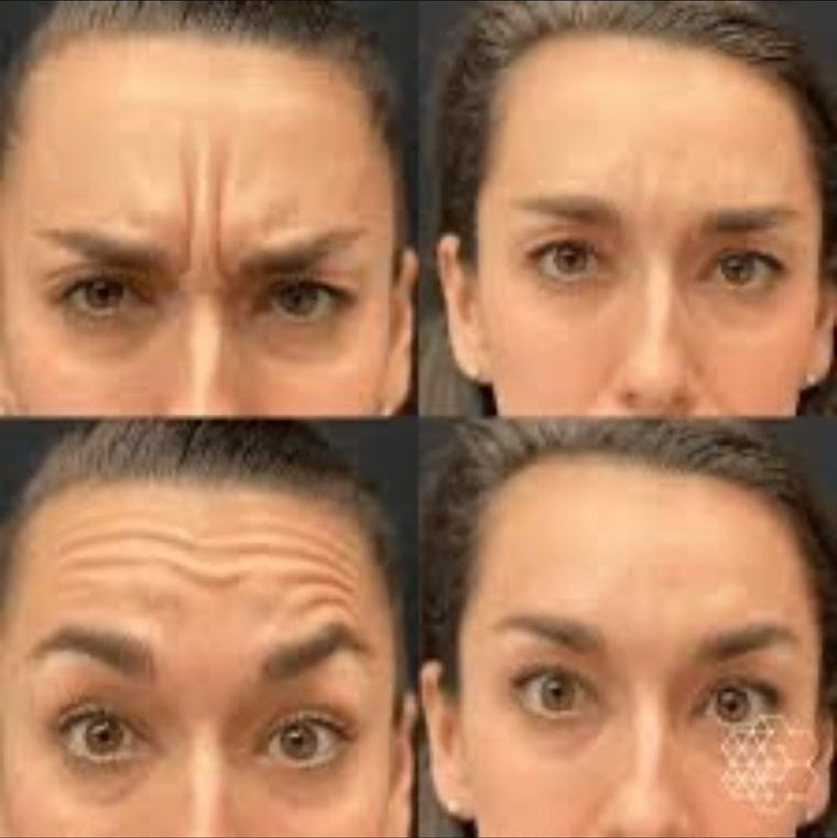 Botox Treatment