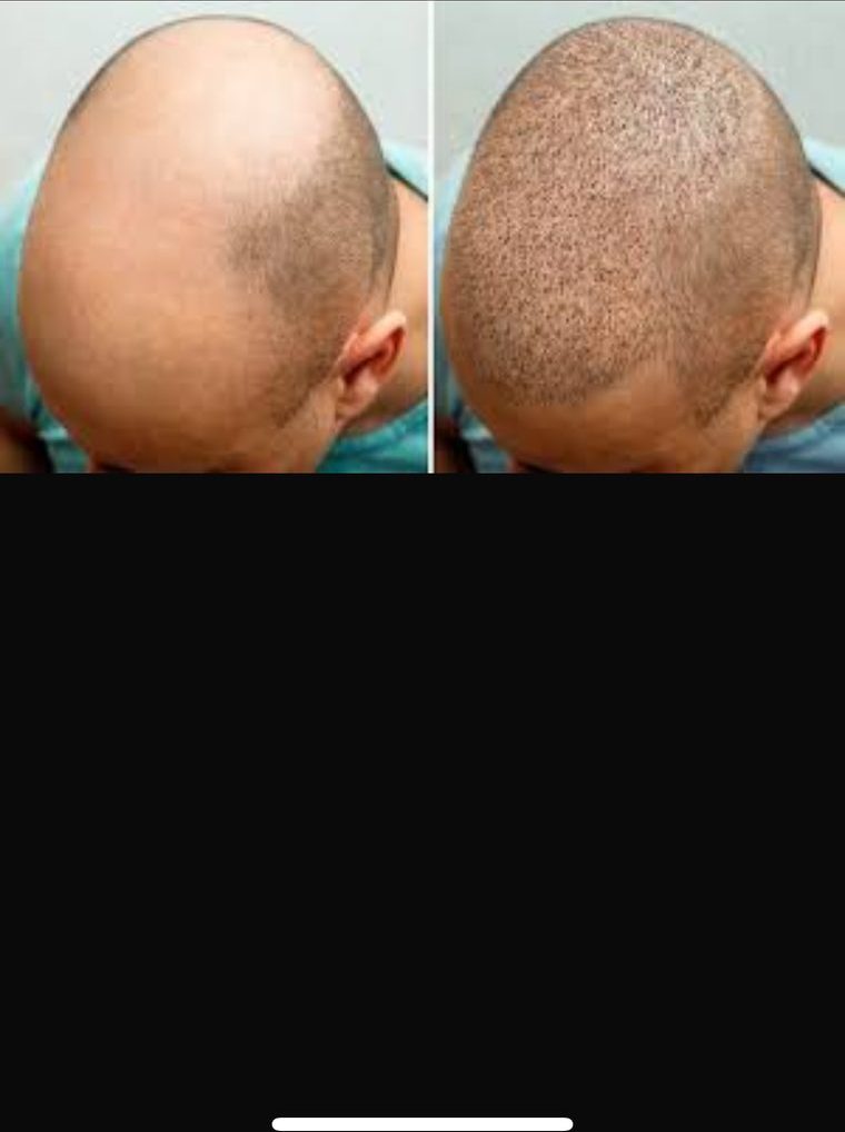 Hair Transplant Treatment